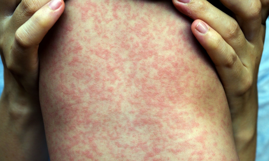 Measles outbreak in Eindhoven as authorities urge vaccinations